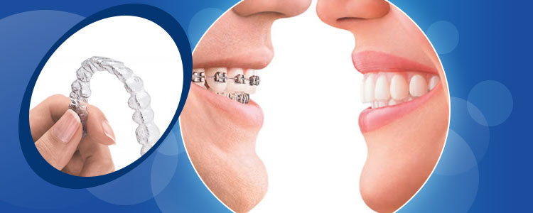 Ortodonzia - Invisalign